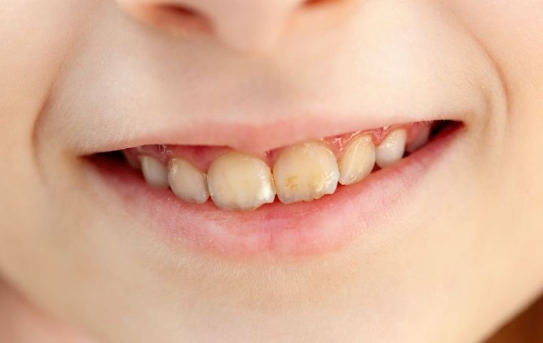 Best Tips, The Ultimate Guide to Teeth Whitening 1 What Causes Teeth Discoloration?