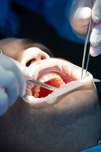 Dental Extractions: Types and Costs Explained 1 pacient in dental clinic while operation