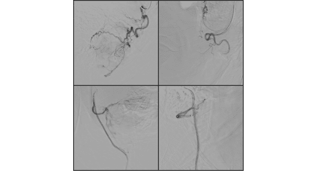 Perm catheter dialysis process