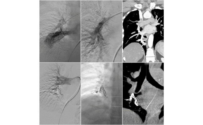 deep vein thrombosis disease process