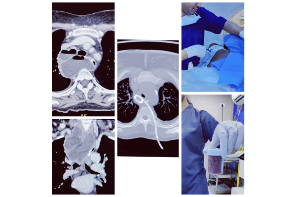 Perm catheter dialysis process