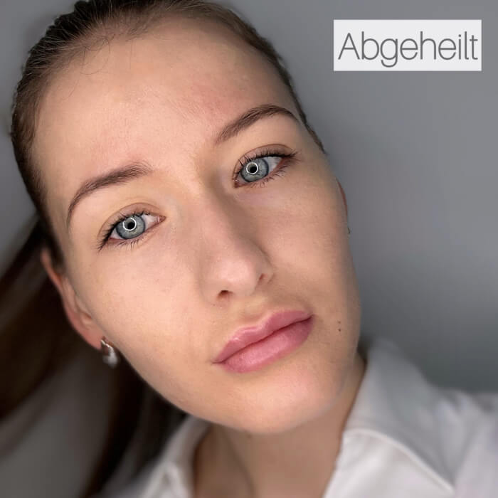 Lippen Pigmentierung - Abgeheilt.