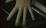 The hand of the patient, turning into broccoli (initial stage)
Translated by «Yandex.Translator»