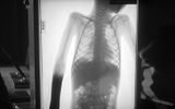 X-ray of a girl who suffered from interaction with a monolith