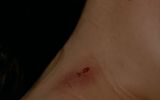 A wound on the woman's neck, similar to a vampire bite mark