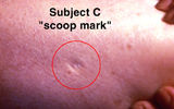 scoop mark on the body of the kidnap victim