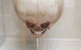 Hydrocephalic fetal skull of the XIX century, Royal Museum of Surgeons, Edinburgh