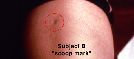 scoop mark on the body of the kidnap victim