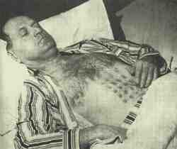 Stefan Михалак en el hospital; en su vientre se ve bien la "malla" de las quemaduras.
Traducido del servicio de «Yandex.Traductor»