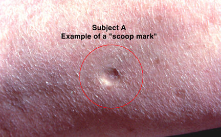 scoop mark on the body of the kidnap victim