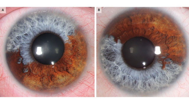 © N Engl J Med 2023; 389:e6. DOI: 10.1056/NEJMicm2301437
