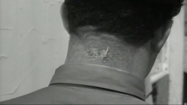 An alien mind control device implanted in the back of a person's head