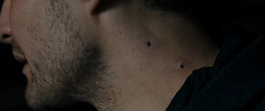 A vampire bite mark on the victim's neck