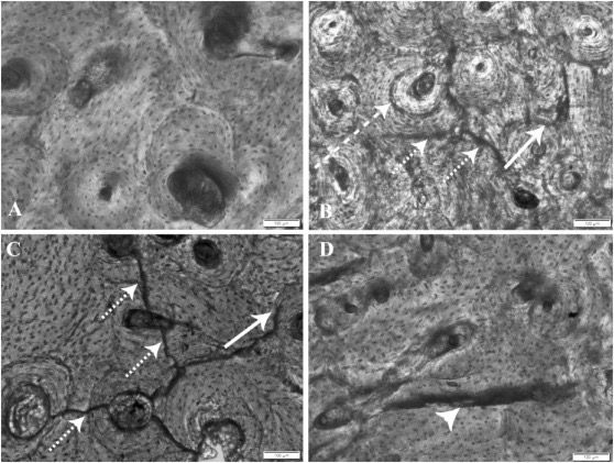 Patterns of microtrauma caused by the passage of experimentally induced current into human bones (in the center) and a well-known case of a fatal natural lightning strike in a young giraffe (below). The control sample (intact) is visible on the upper panel. Courtesy: Patrick Randolph-Quinney /Forensic Research Group, University of Northumbria, and Tanya Augustine and Nicholas Bacci, School of Anatomical Sciences, Wits University