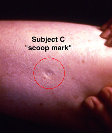 scoop mark en el cuerpo de la víctima de secuestro