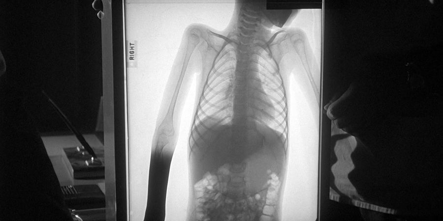 X-ray of a girl who suffered from interaction with a monolith