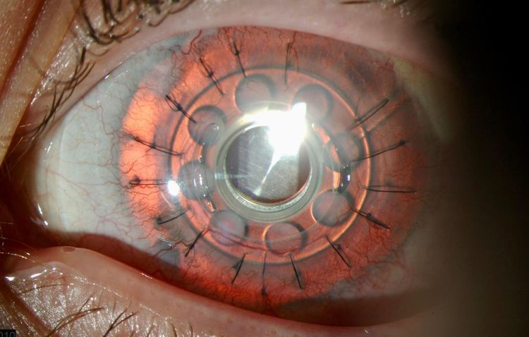 Córnea artificial implantada en el ojo del paciente