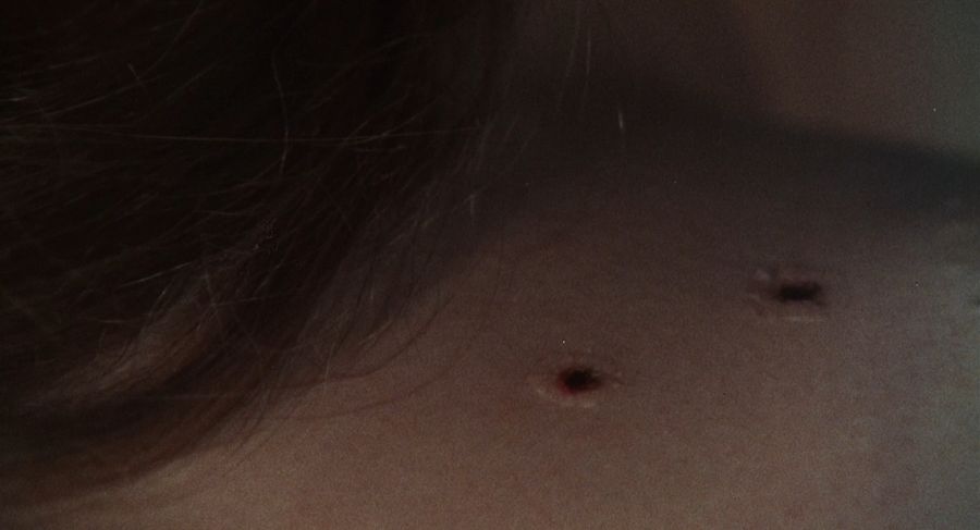 Vampire bite marks on the victim's chest