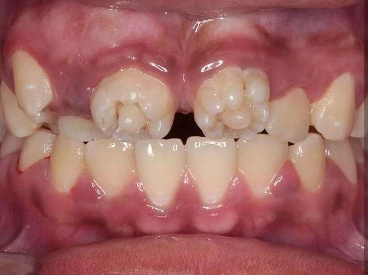 Fournier's teeth are a dental disease usually associated with congenital syphilis 