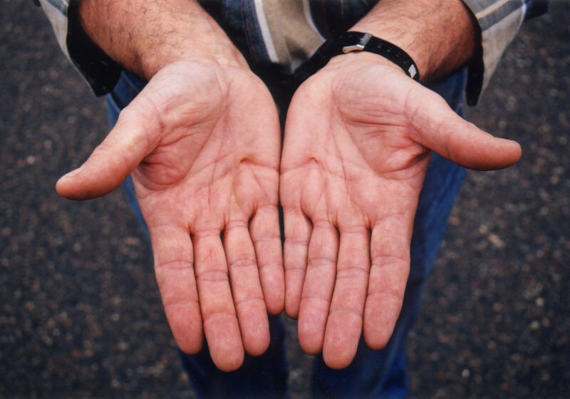 The marks were left on Kevin's hands after the incident. The photo was taken on July 9, 2000, almost 13 years later.