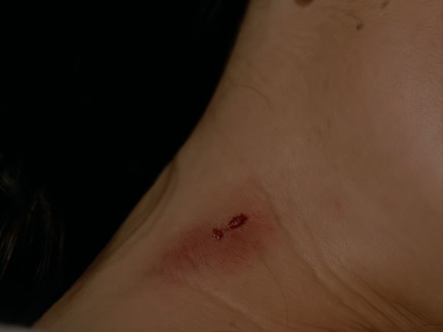 A wound on the woman's neck, similar to a vampire bite mark