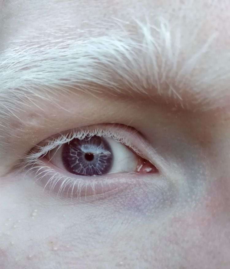 The purple shade of the eyes of a person with albinism