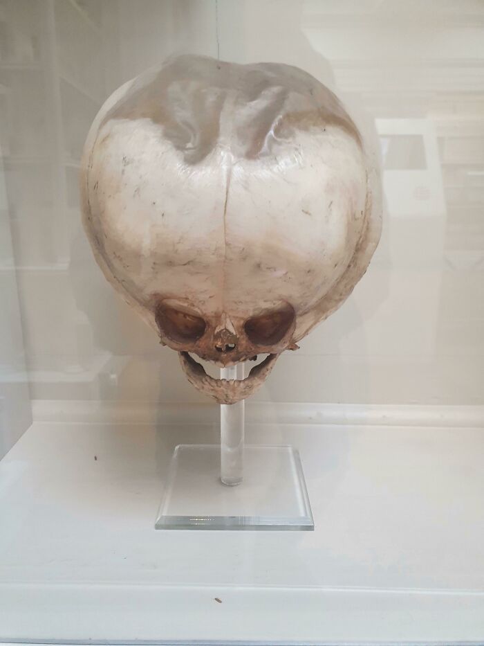 Cráneo fetal hidrocefálico del siglo XIX, Museo real de cirujanos, Edimburgo