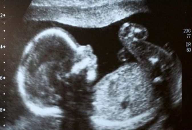 pregnancy 1522135326