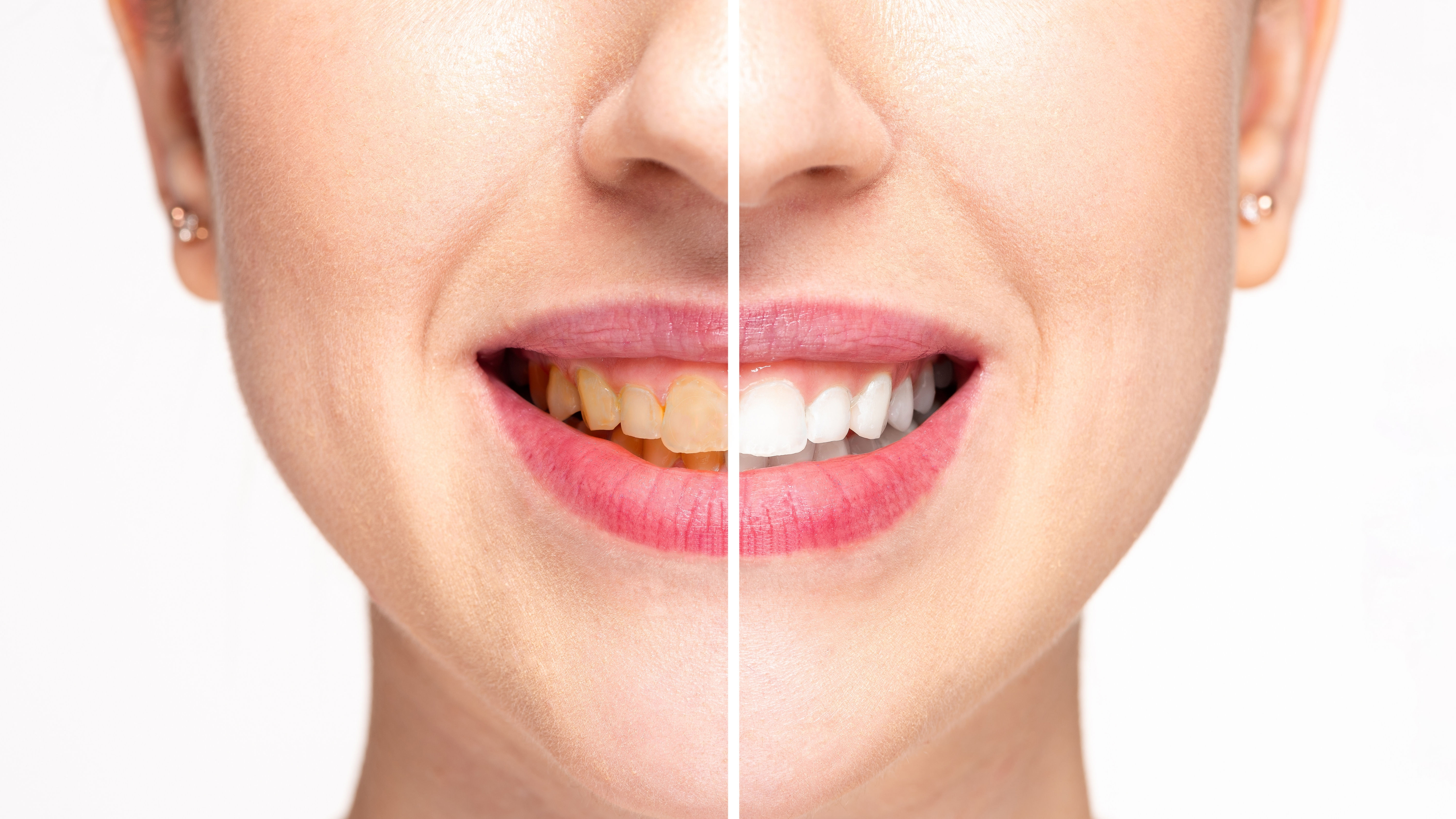before and after professional teeth whitening at dentist
