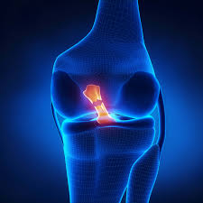 acl rehab