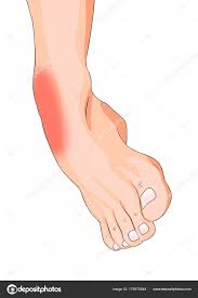 ankle sprain