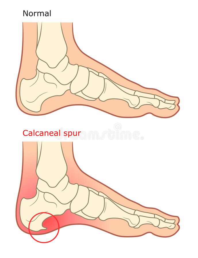 calcaneal-spur