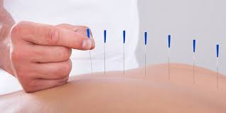 dry needling