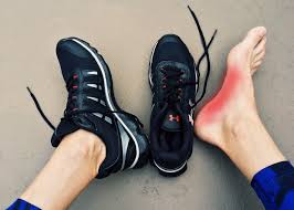plantar-fascitis
