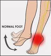 foot foot-drops