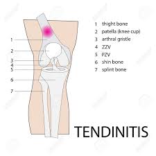 tendinitis