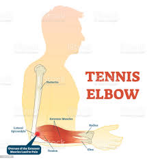 tennis elbow