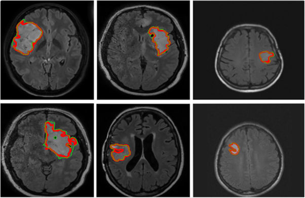 regions with different tissue densities regions with different tissue densities
