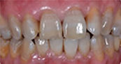 after whitening