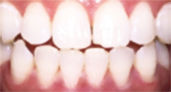after whitening