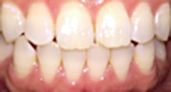 before whitening