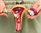 PCOS and Infertility: Understanding the Primary Causes and Management Strategies