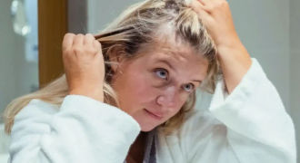 dandruff hair problem
