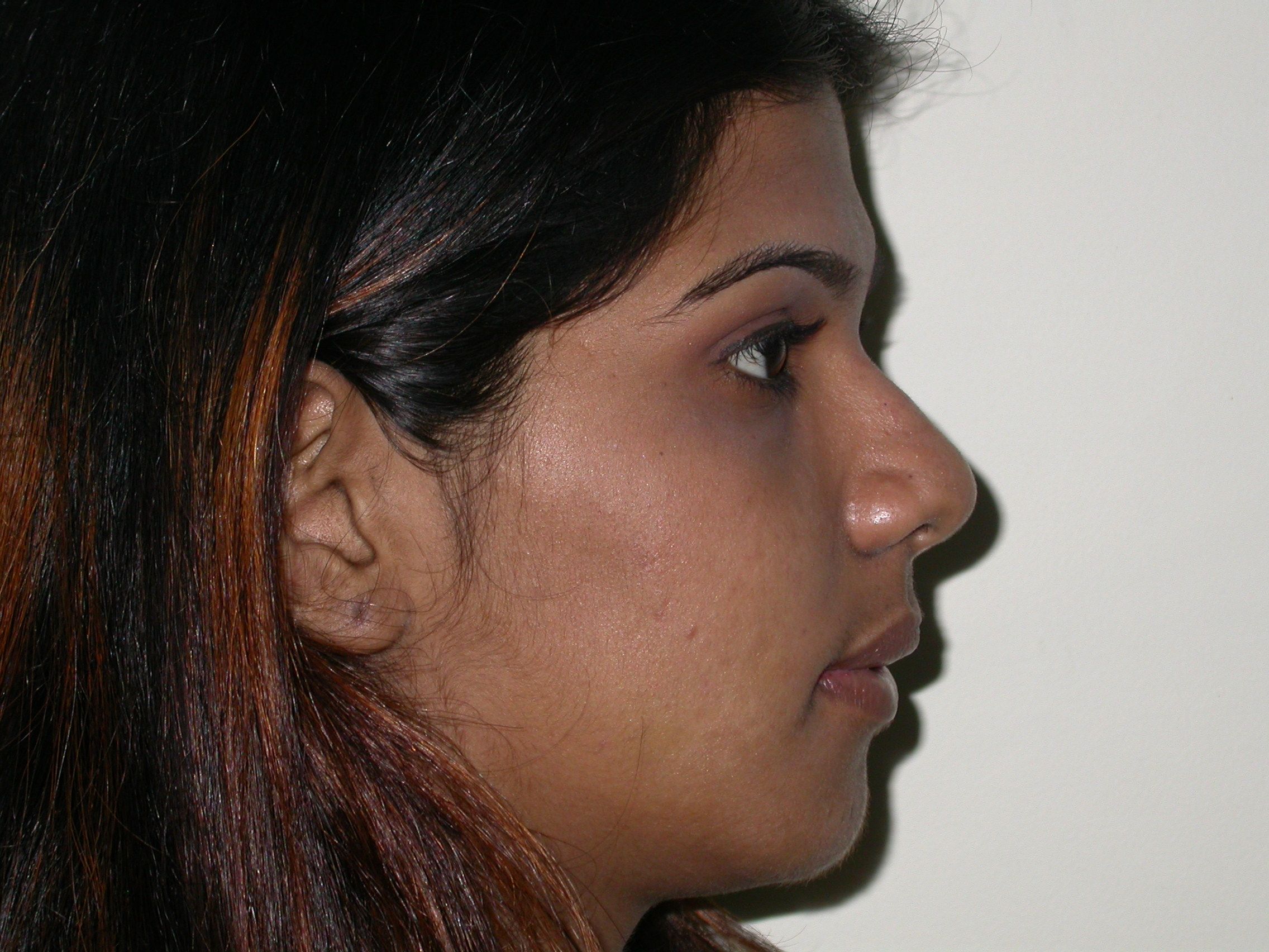 Thyroid Eye Disease