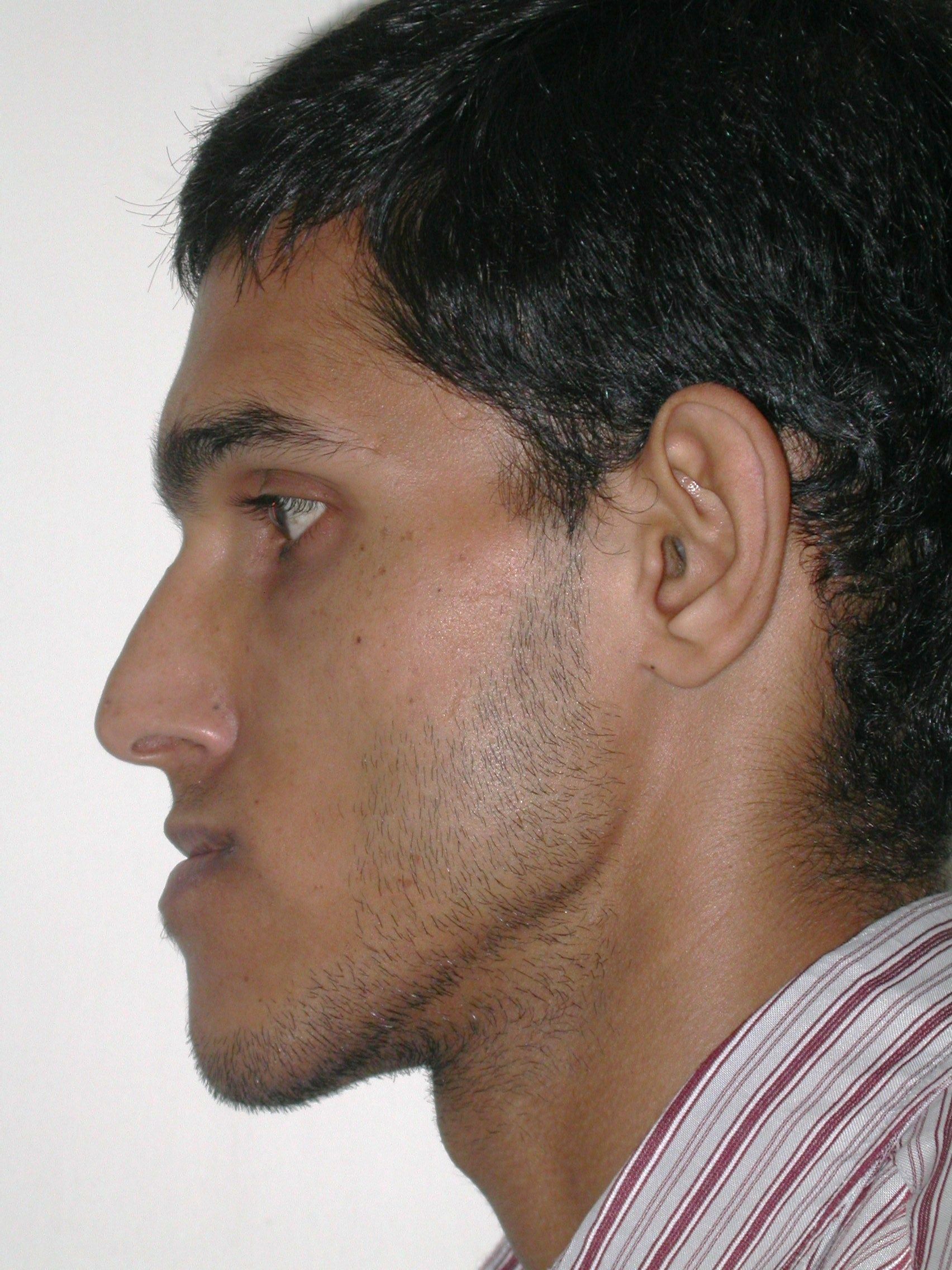 Before and After Orthognathic Surgery