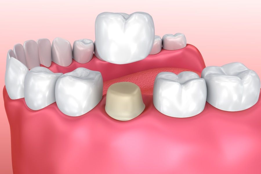 Dental crown treatment
