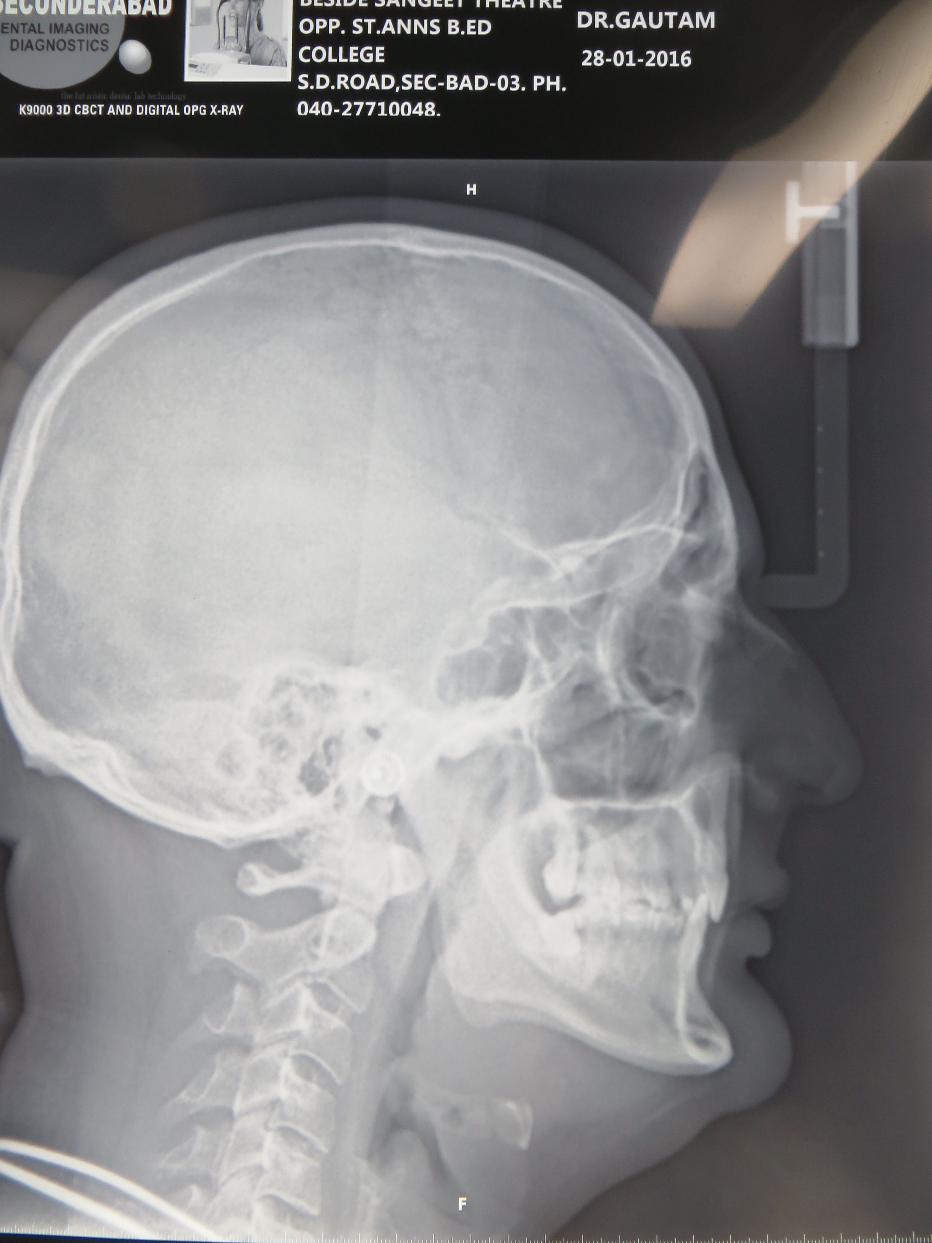 Jaw Widening Procedure