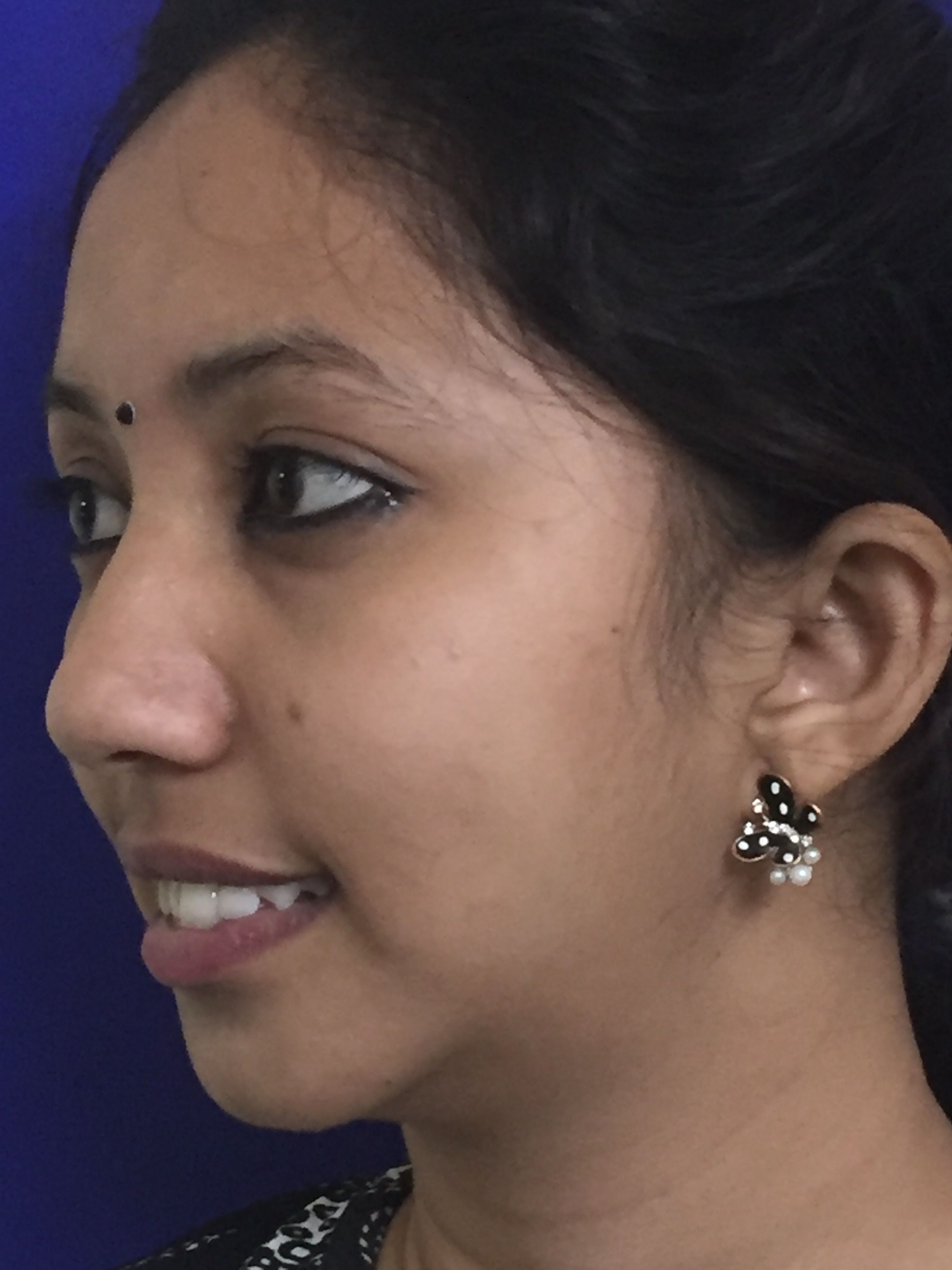 Droopy Eyelid