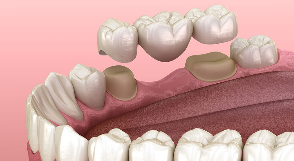 Dental bridge procedure