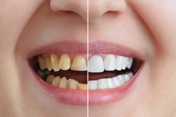 Cosmetic dentistry smile makeover